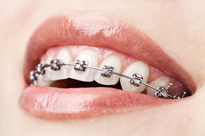 Jak i czym myć zęby z aparatem ortodontycznym?