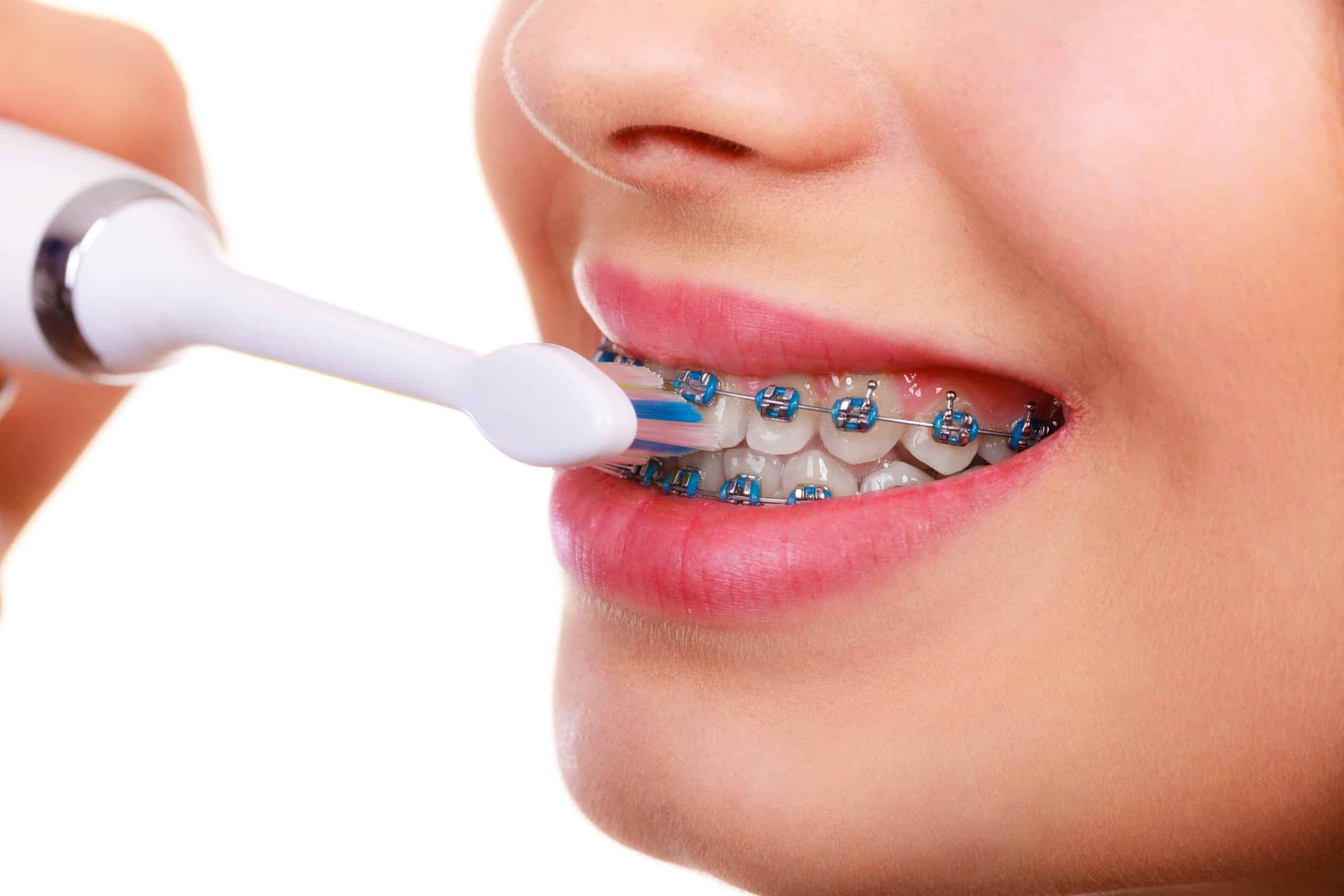 mycie zębów z aparatem ortodontycznym